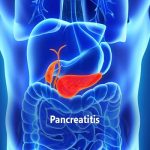 Pancreatita cronica
