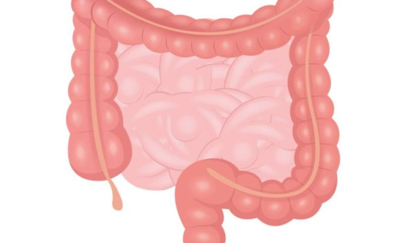 Pseudoocluzia intestinala cronica