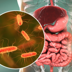 Sindrom de suprapopulare microbiana (SIBO)